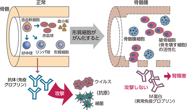 多発性骨髄腫について 多発性骨髄腫の治療でニンラーロを服用される方へ ニンラーロ Jp